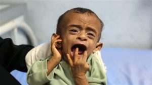 yemen starving child